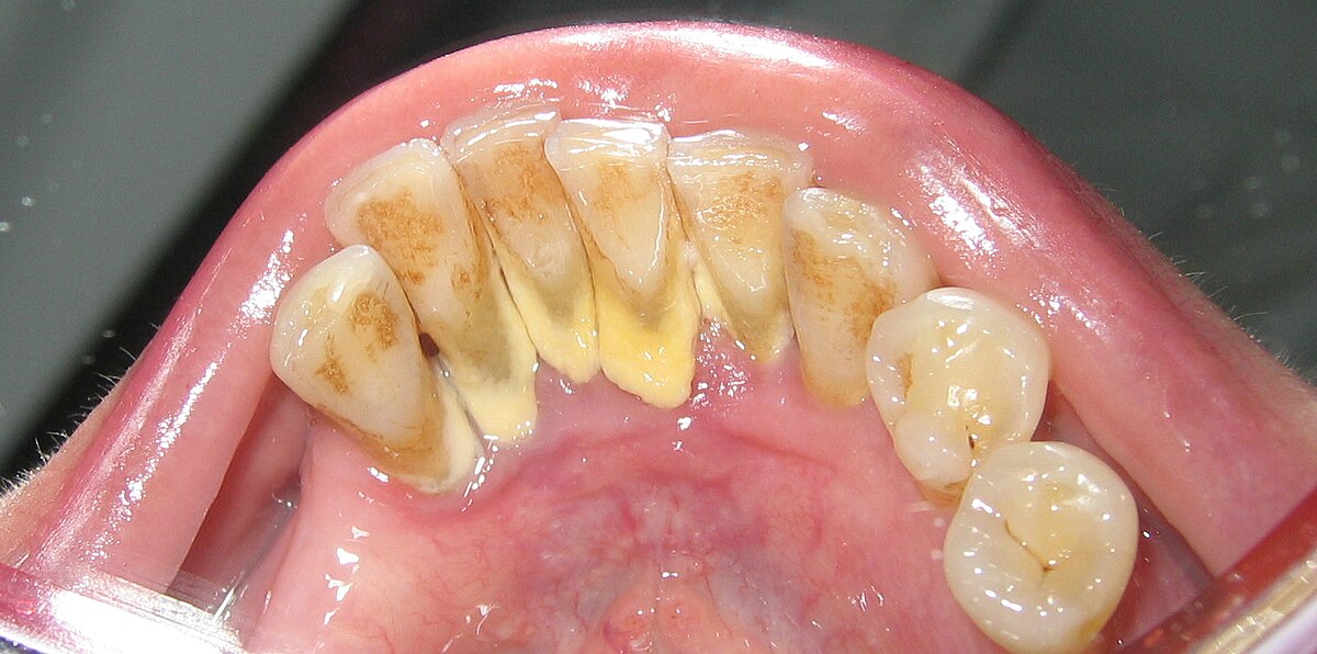 Calculus on Teeth