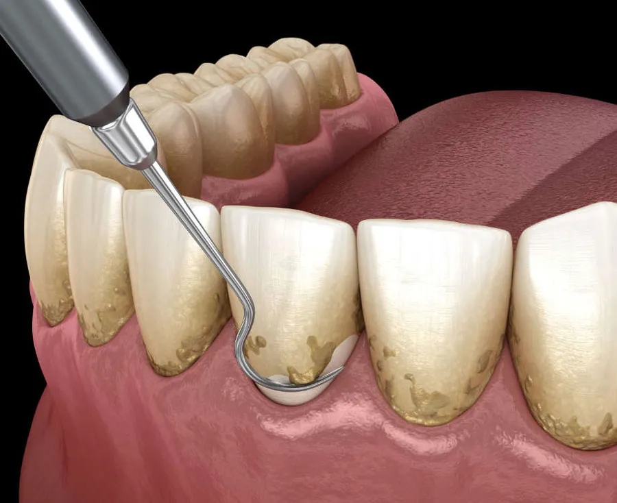 Get Rid of Calculus on Teeth