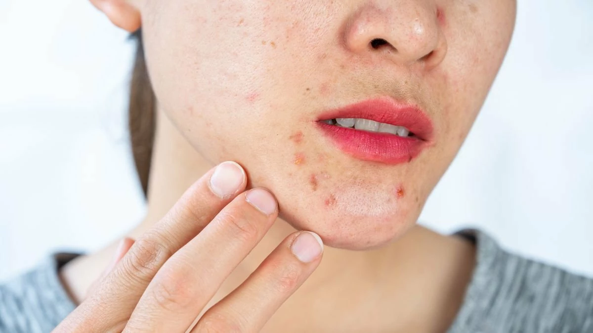 How to Get Rid of Acne Around Mouth At Home