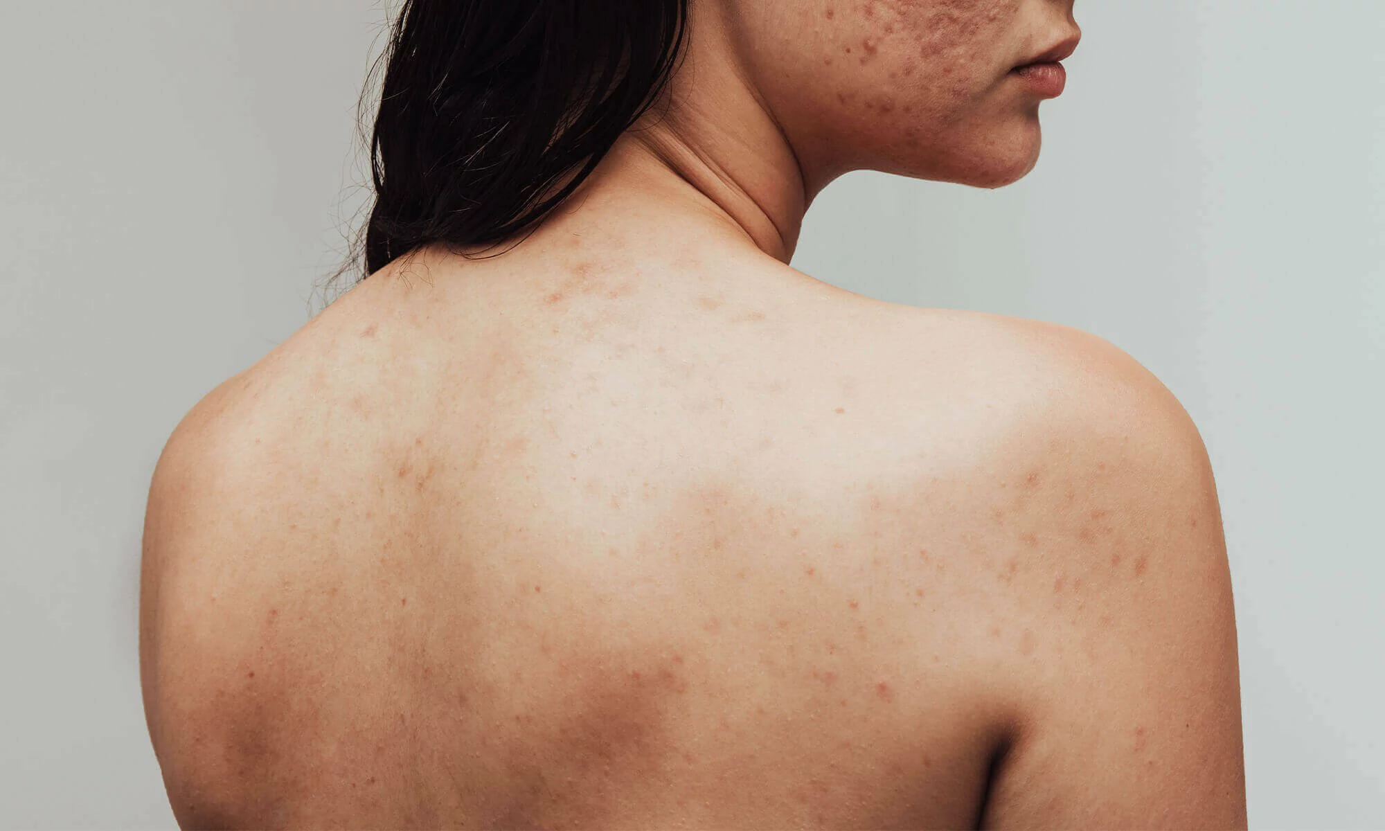 How to Get Rid of Acne on Shoulders Fast