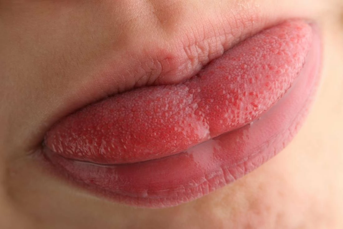 How to Get Rid of An Inflamed Taste Buds