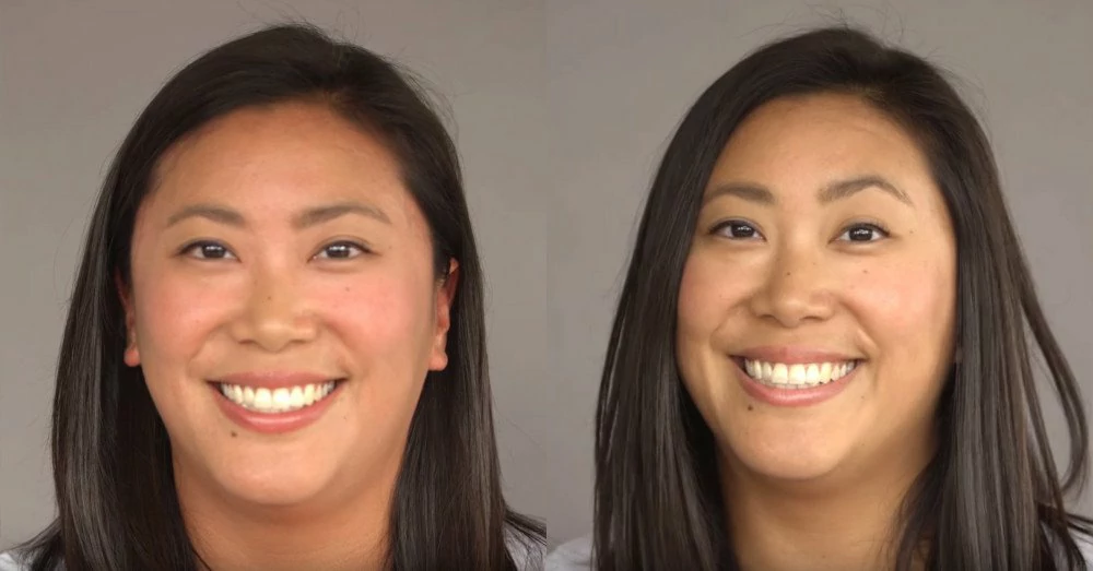 How to Get Rid of Asian Glow