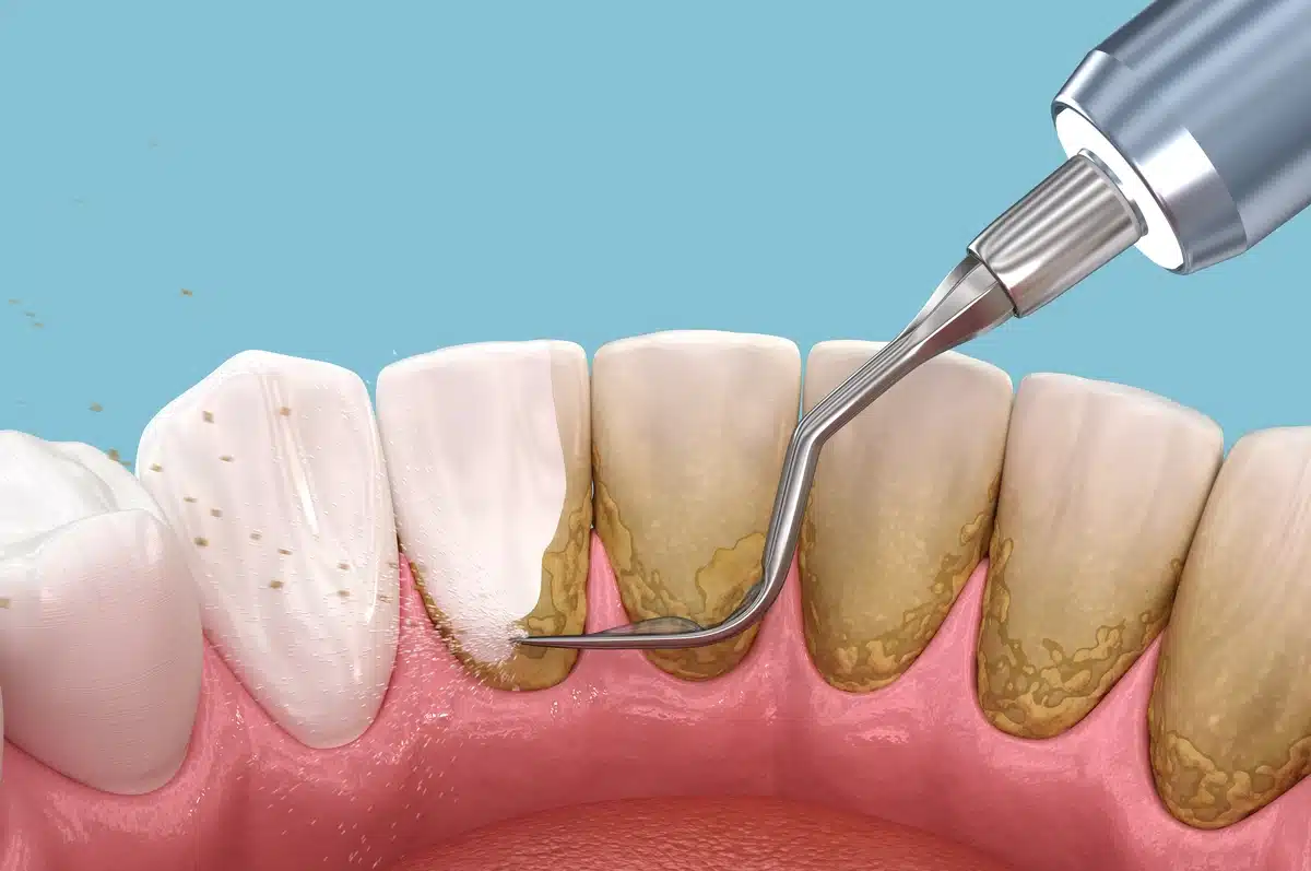 How to Get Rid of Calculus on Teeth