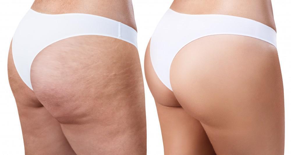 How to Get Rid of Cellulite on Butt