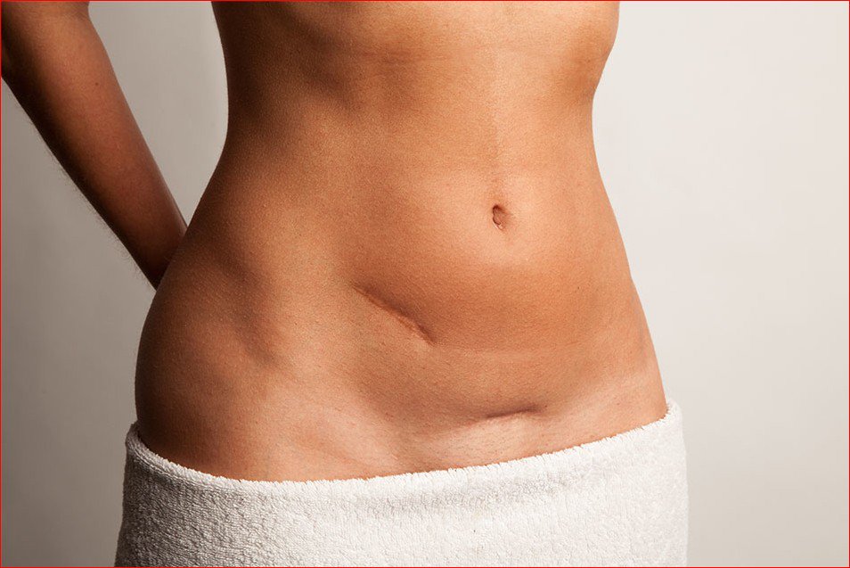 Lumps After Liposuction