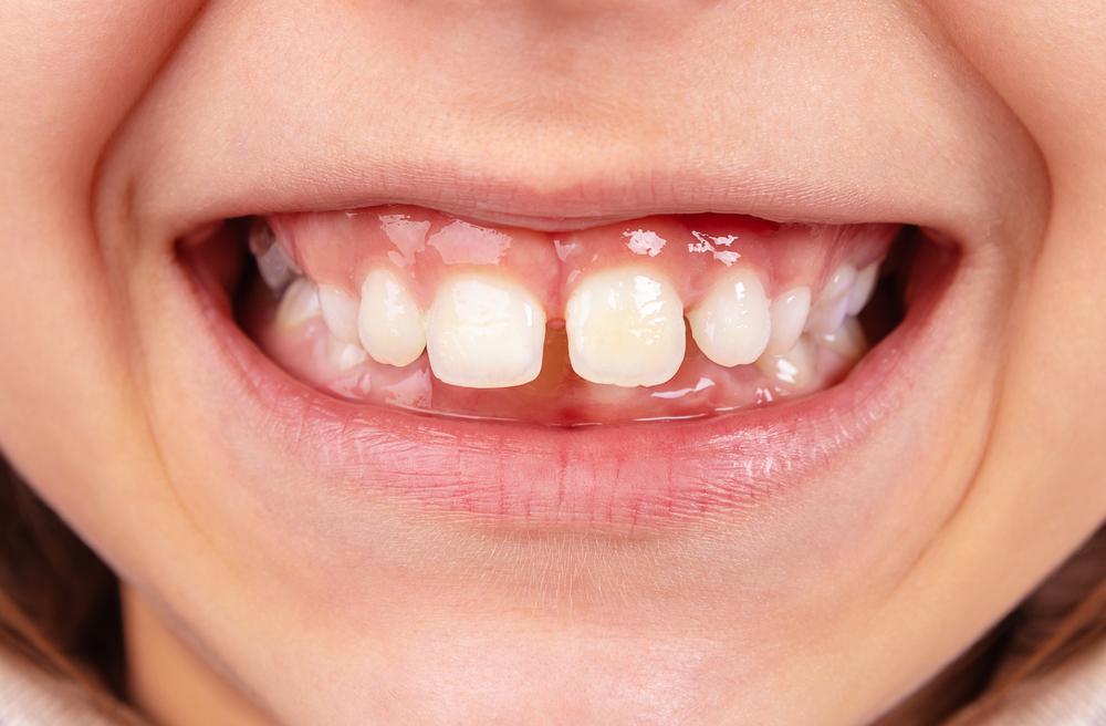 Treatment Options For Fixing a Gap Between Teeth